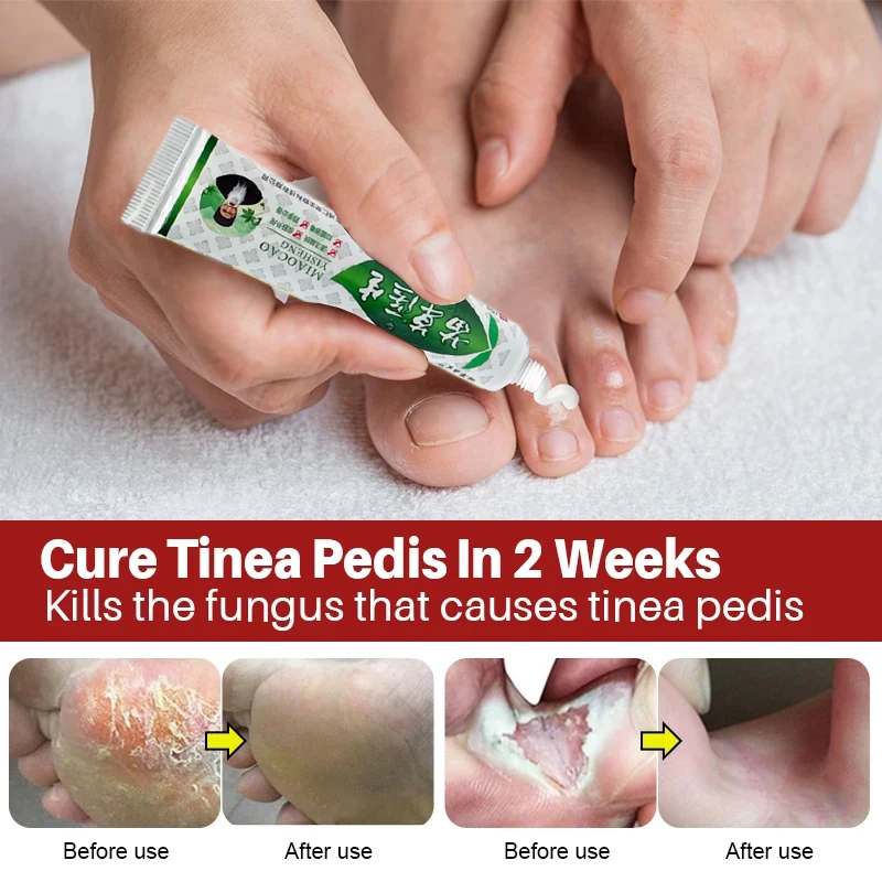 

15g Foot Antibacterial Ointment Effective Tinea Pedis Foot Deodorant Medical Dressing Beriberi Treatment Antifungal Cream