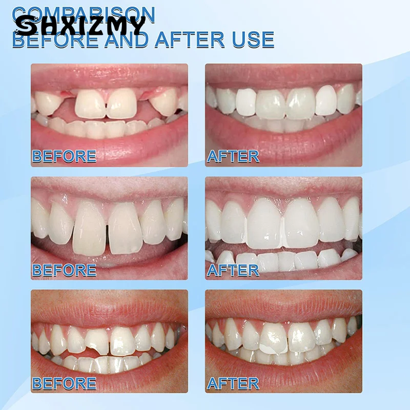 Набор для временного ремонта зубов клейкий клей и отбеливания 30 мл