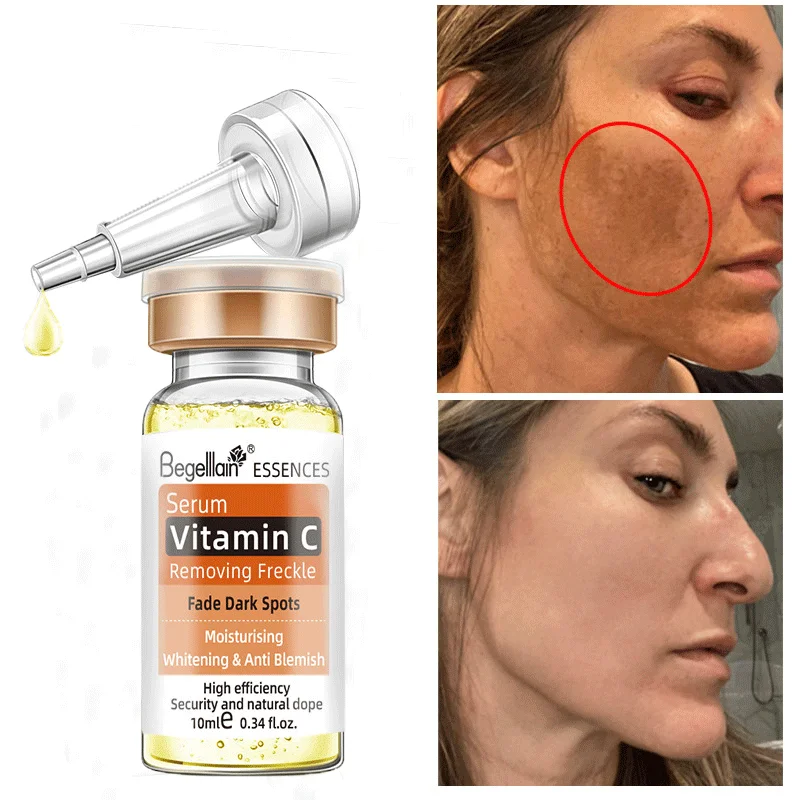 

Whitening Freckles Serum Remove Dark Spots Freckle Melasma Brighten Lighten Melanin Improve Dull Anti-aging Face Skin Care 10ml