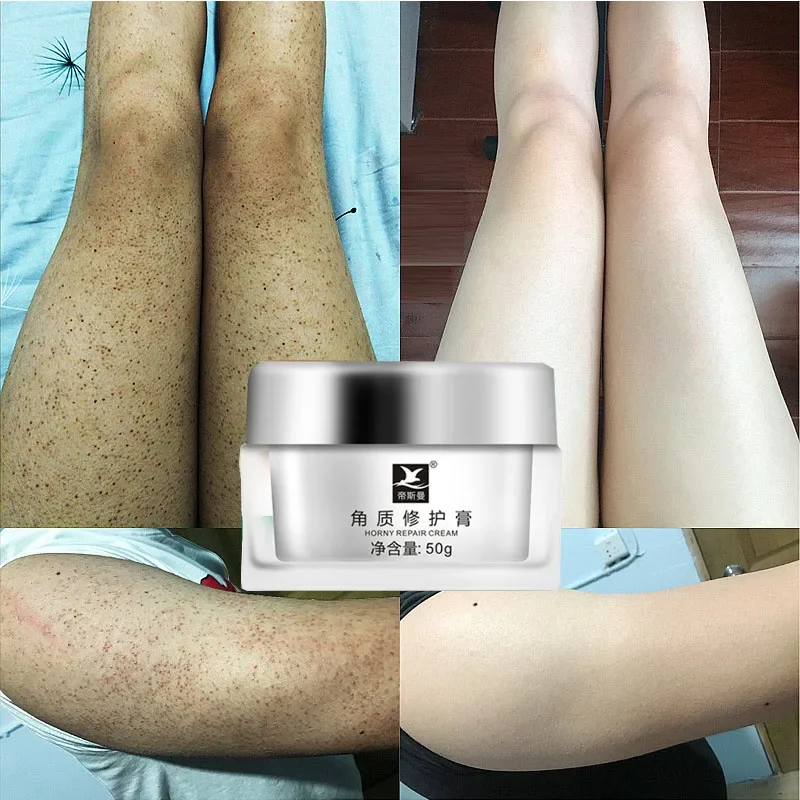 Крем для кожи курицы восстановления волос вокруг тела удаления гусиных ударов