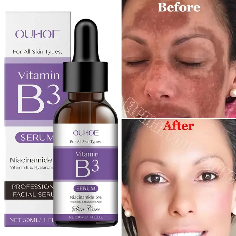 Отбеливающая сыворотка для лица удаляющая пятна быстрое устранение пигментации