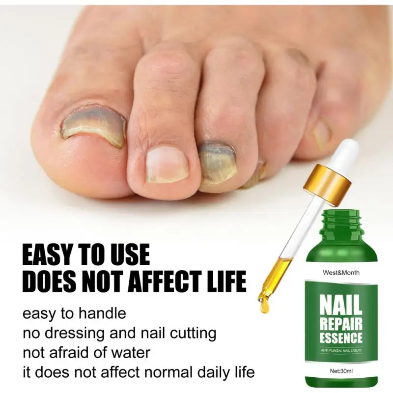 

30ml Fungal Nail Repair Serum Care Treatments Foot Nail Fungus Removal Gel Anti-Infect Paronychia Onychomycosis Nail Care