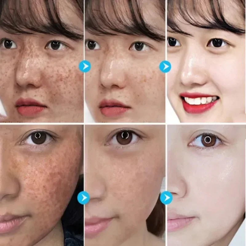 Осветляющий крем для лица Ниацинамид уменьшает концентрацию хлоазмы мелазмы