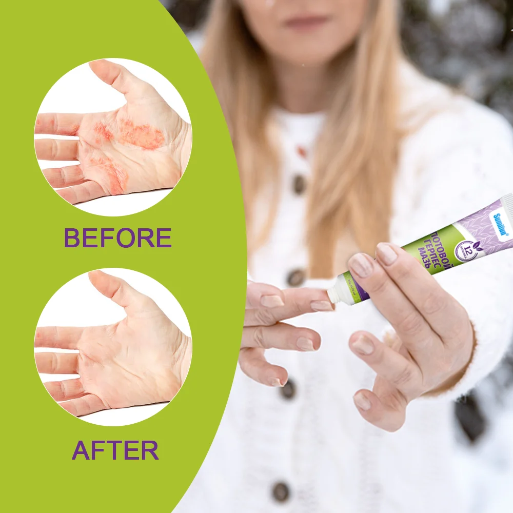 1/3/5/10/20 шт. крем для лечения герпеса пота снимает сверх кожи антибактериальная