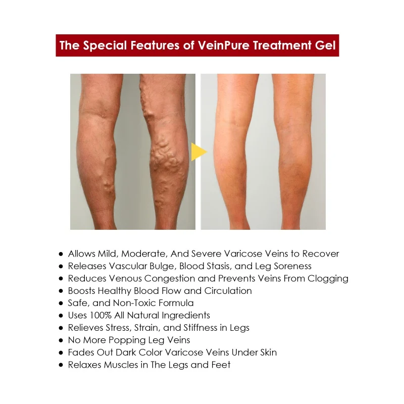 New Varicose Veins Gel Spider Treatment Relief for Legs Repair Natural Massage | Body Creams
