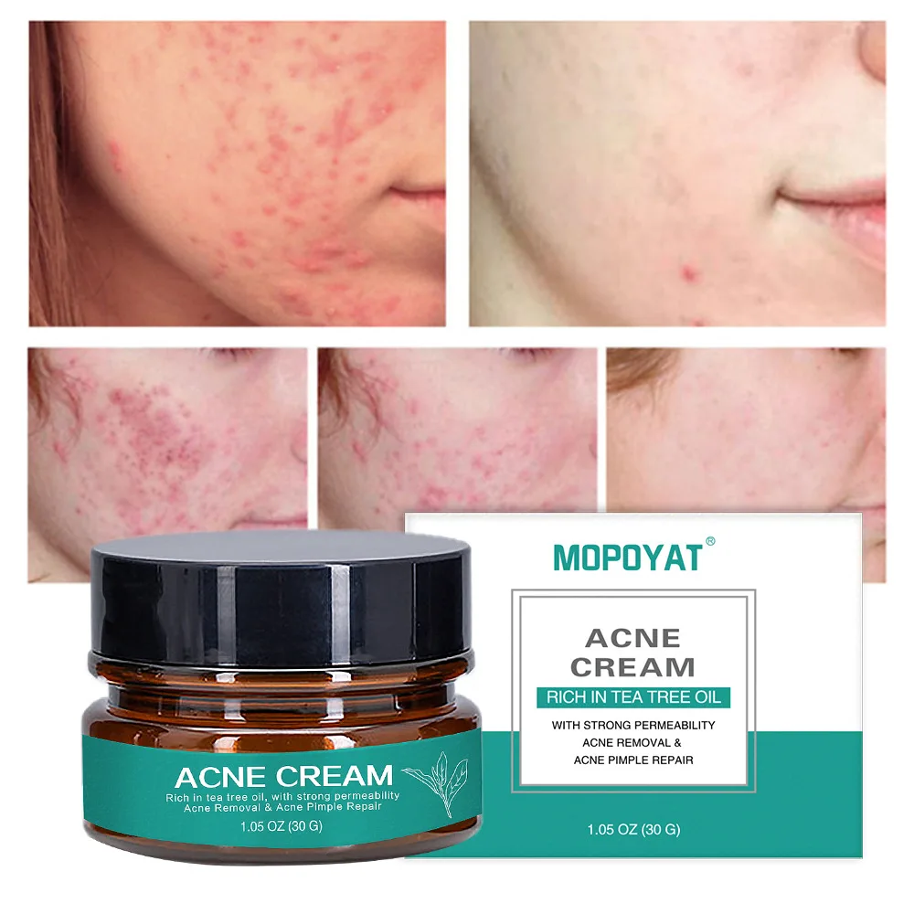 30ml Herbal Anti-Acne Cream To Improve Acne Skin Acne Repair Oil Control Acne Cream Free Shipping