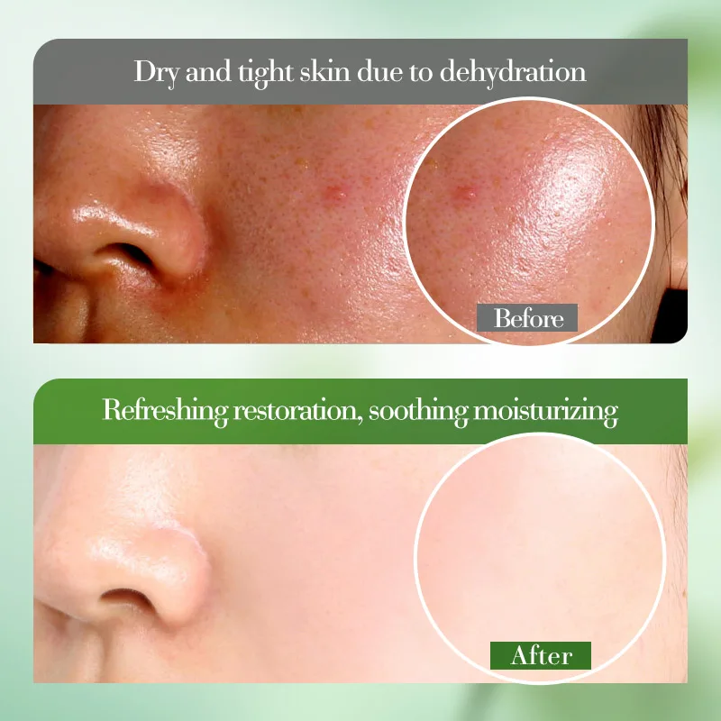 99% гель алоэ вера для лица, тела, увлажняющий успокаивающий после солнца, восстанавливающий крем, увлажняющий охлаждающий гель для солнечных ожогов, акне, нежной кожи (art.: 3920d161c09e0) - 3920d161c09e0