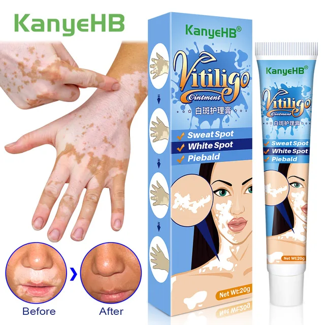 20g Herbal Extract Vitiligo Ointment Remove Ringworm White Spot Removal Skin White Spot Leukoplakia Disease Treatment Cream 1
