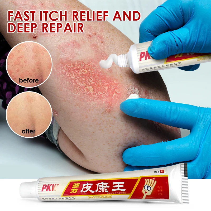 2 шт. антибактериальный крем для лечения псориаза