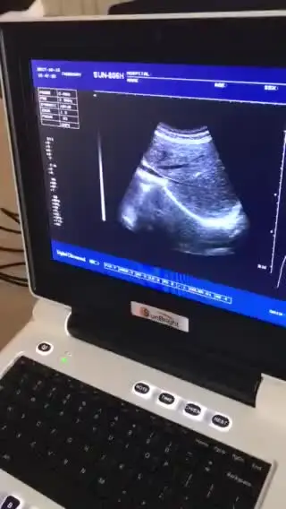 

Hot Sale Full digital ultrasonic equipment BW USG portable laptop ultrasound device price