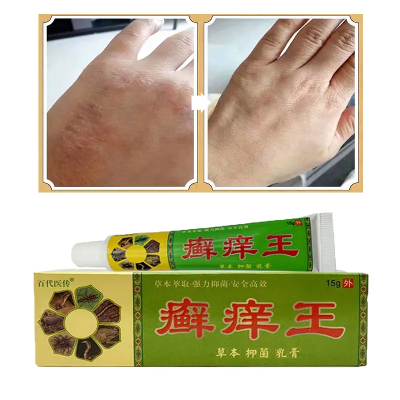 

Anti Fungal Infection Skin Care Products Effective Anti-Itch Psoriasis Antibacterial Cream Dermatitis Eczematoid Ointment