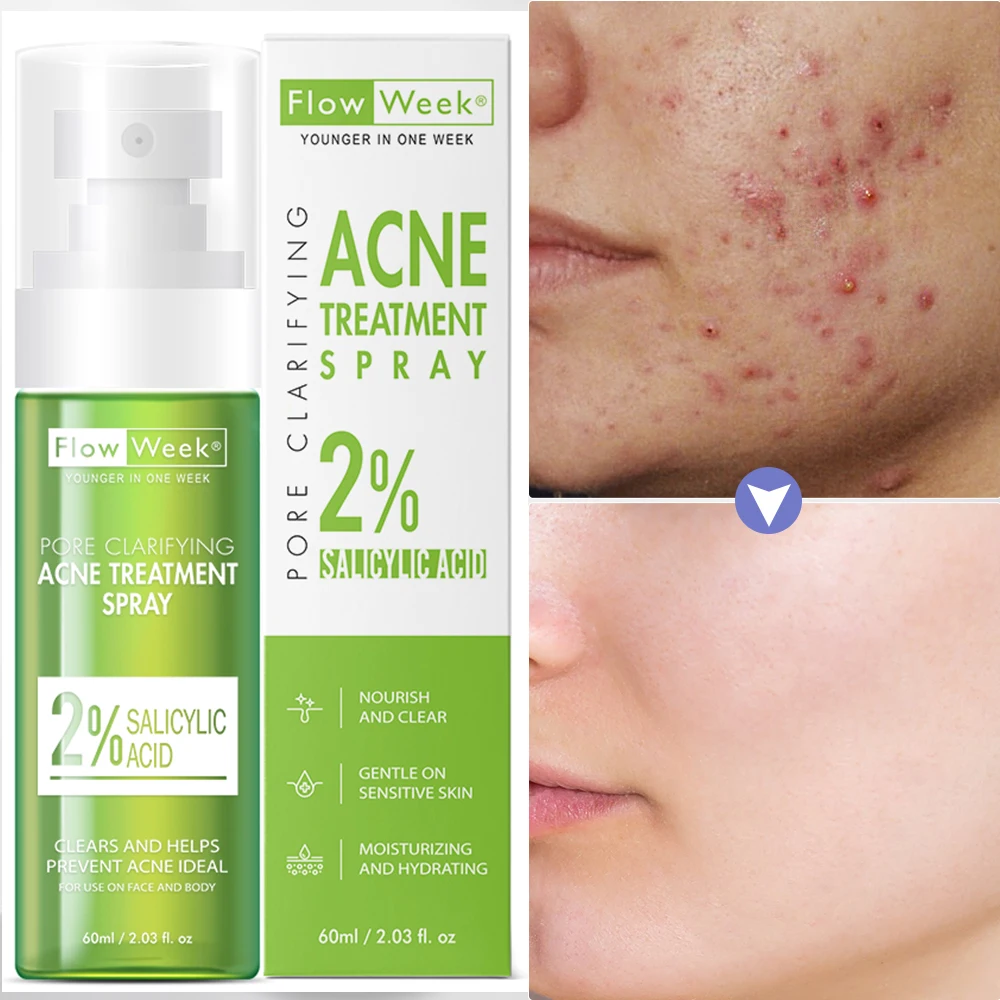 

Acne Treatment Spray Skin Care Beauty Health Moisturizing Nourish Smooth Pores Repair Essence Firm for mixed, oily and acne skin