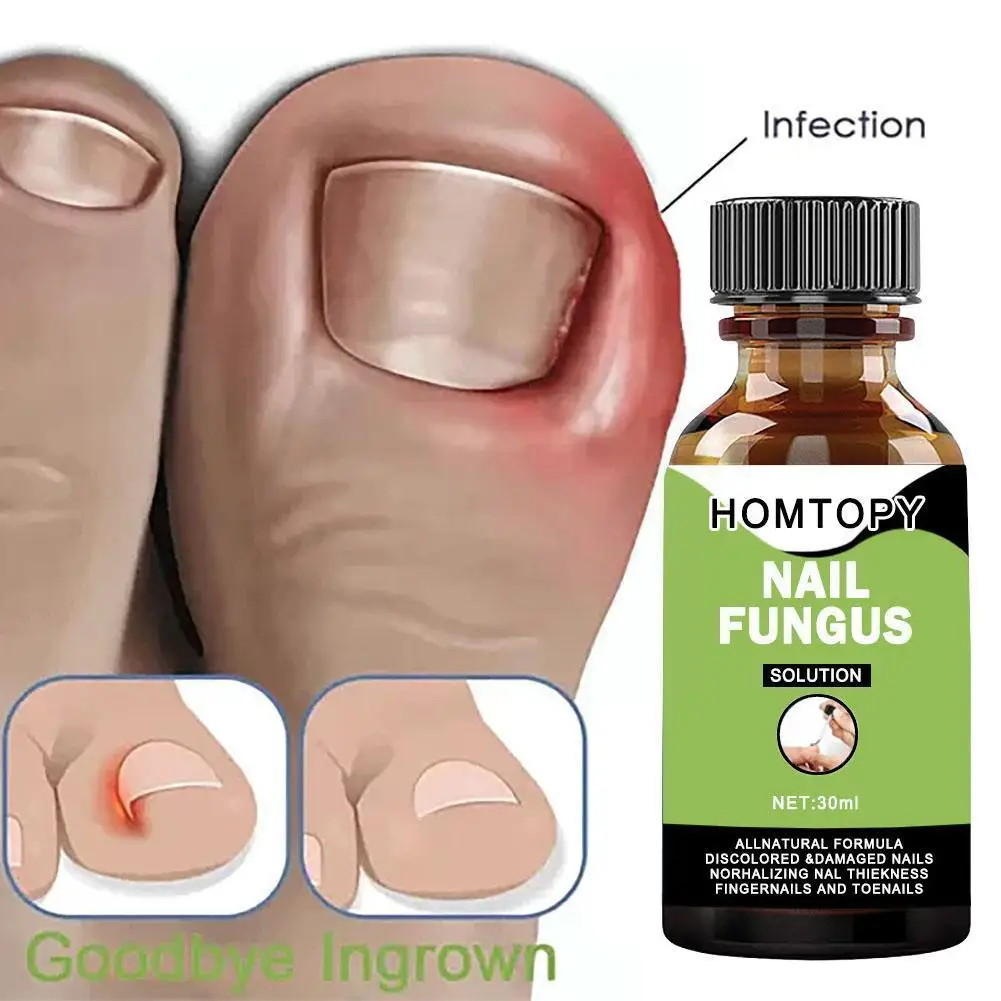 

30ml Nail Fungal Treatment Feet Care Essence Anti Infection Paronychia Onychomycosis Fungus Removal Gel Foot Toe J4S8