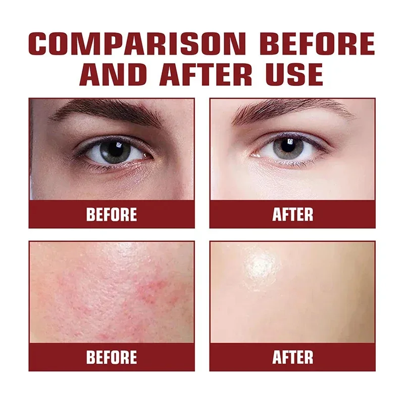 Сыворотка для сужения пор пилинг лица удаление больших подтяжка восстановление