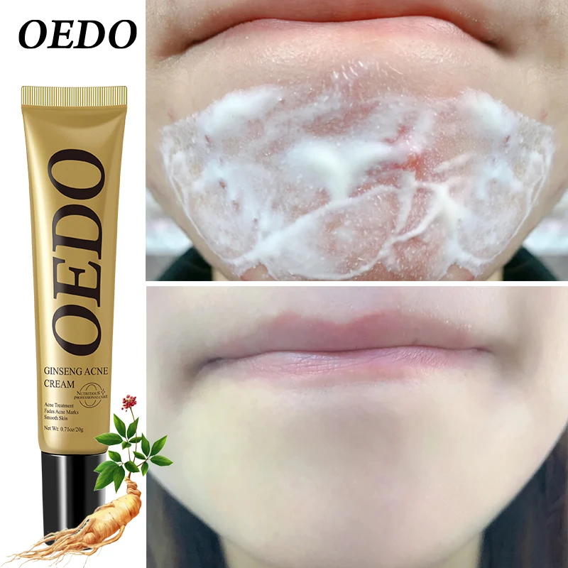2PCS Anti Acne Treatment Face Cream For Women Men Plant Extraction Ginseng Scutellariae Extract Repair Whitening Facial Serum - купить по