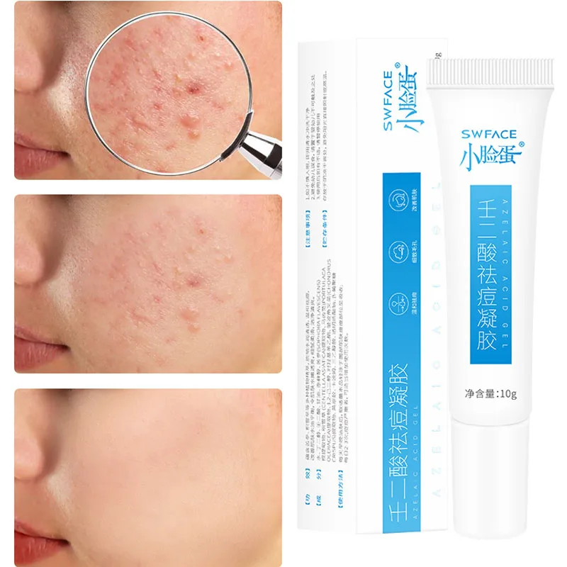 

Acne Gel Azelaic Acid Stock Solution Remove Acnes Pimple Dark Spot Scars Anti Acne Treatment Clean And Shrink Pores Oil Control
