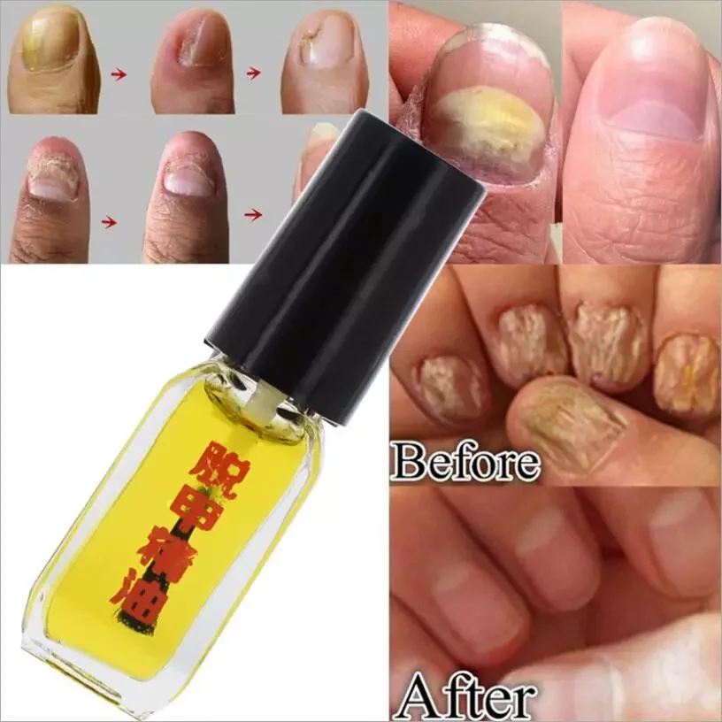 

NEW 2021 3 Days Effect Treatment Removal of onychomycosis Paronychia Anti oil Fungal Nail Infection Toe Nail Fungus oil