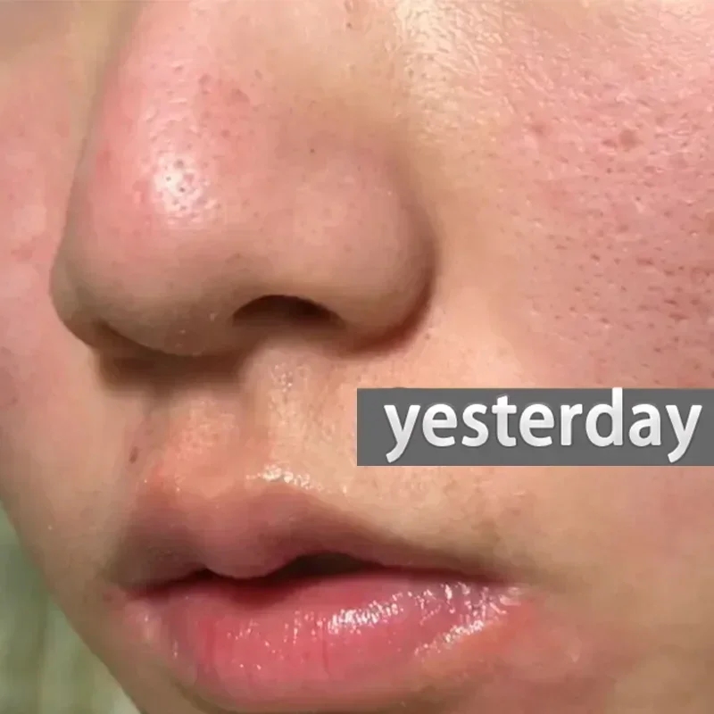 Эссенция для устранения всех пор лица укрепляющая восстанавливающая