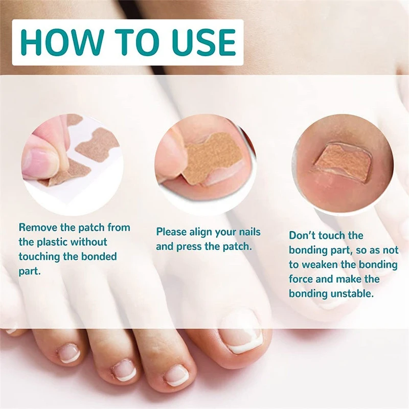 100 шт. пластырь для ногтей с грибком восстановления вросших Наклейка коррекции