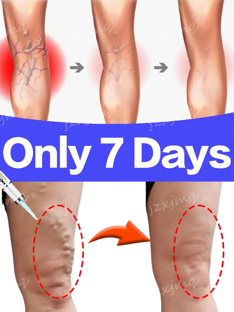 Лазерный крем Varicosse