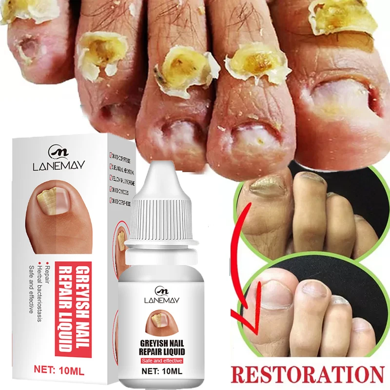 Nail Fungal Treatment Serum Hand Foot Anti-Infective Paronychia Onychomycosis Essence Toe Nail Fungus Removal Gel Nourish Care