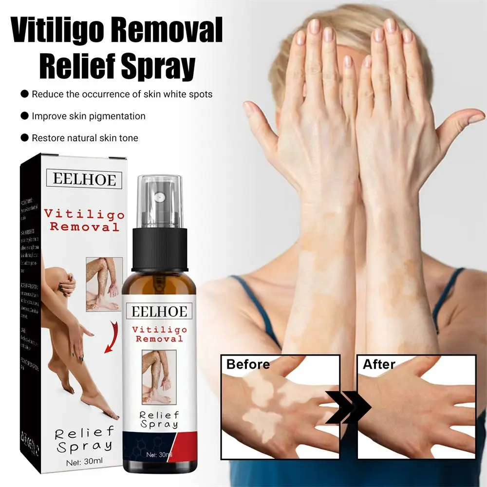 

30ml Vitiligo Relief Spray Skin Moisturizing Vitiligo Net Spray Skin Repair Body Face Fades Vitiligo Spot Repair Body Care 1/2PC