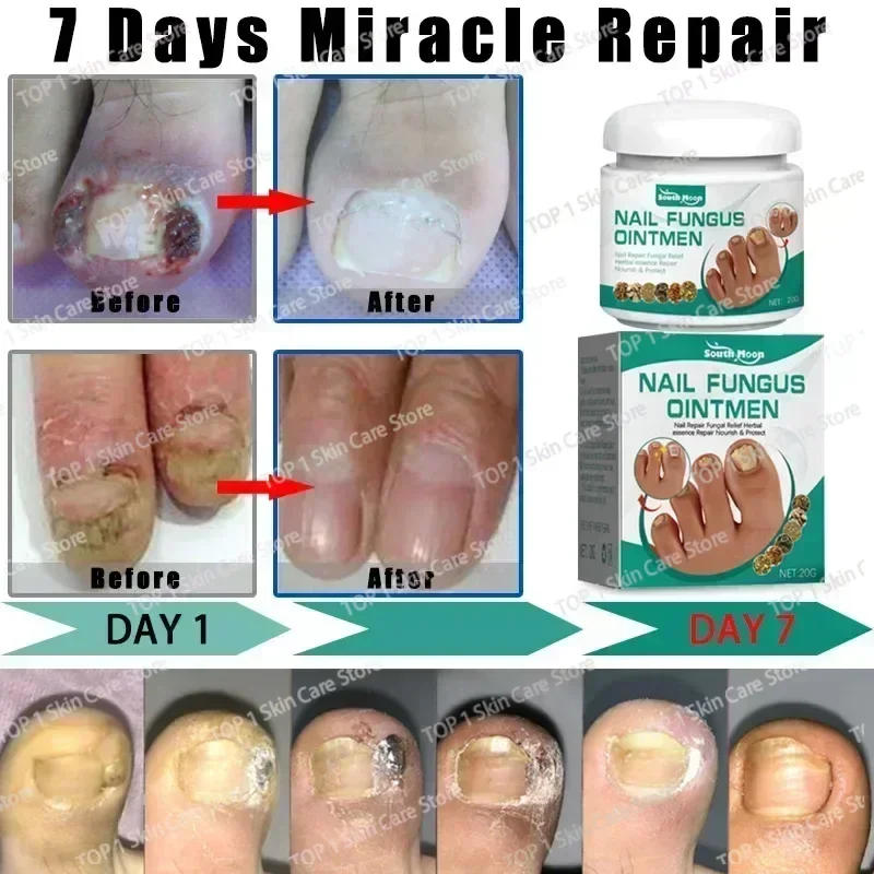 Антиинфекционный онихомикоз лечение грибка ногтей сыворотка для восстановления