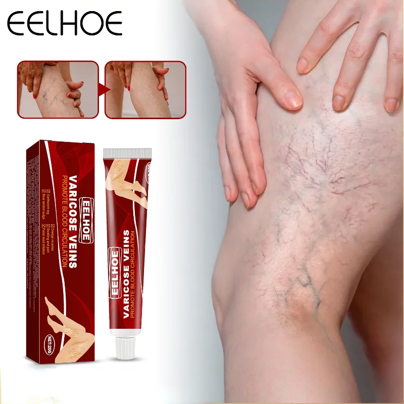 

Крем для лечения варикозного расширения вен, снимает выпуклость ног, воспаление вен, раньше, медицинская мазь для тела, уход за кожей бокс