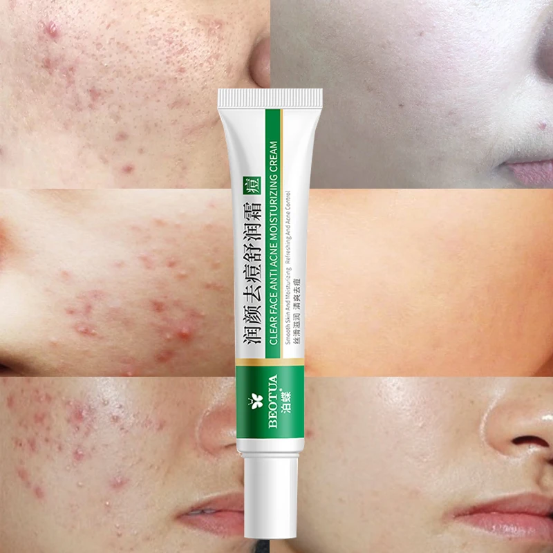 

Herbal Acne Removal Cream Anti-Acne Oil Control Repair Moisturizing Face Gel Cream Whitening Brightening Health Skin Care Cream