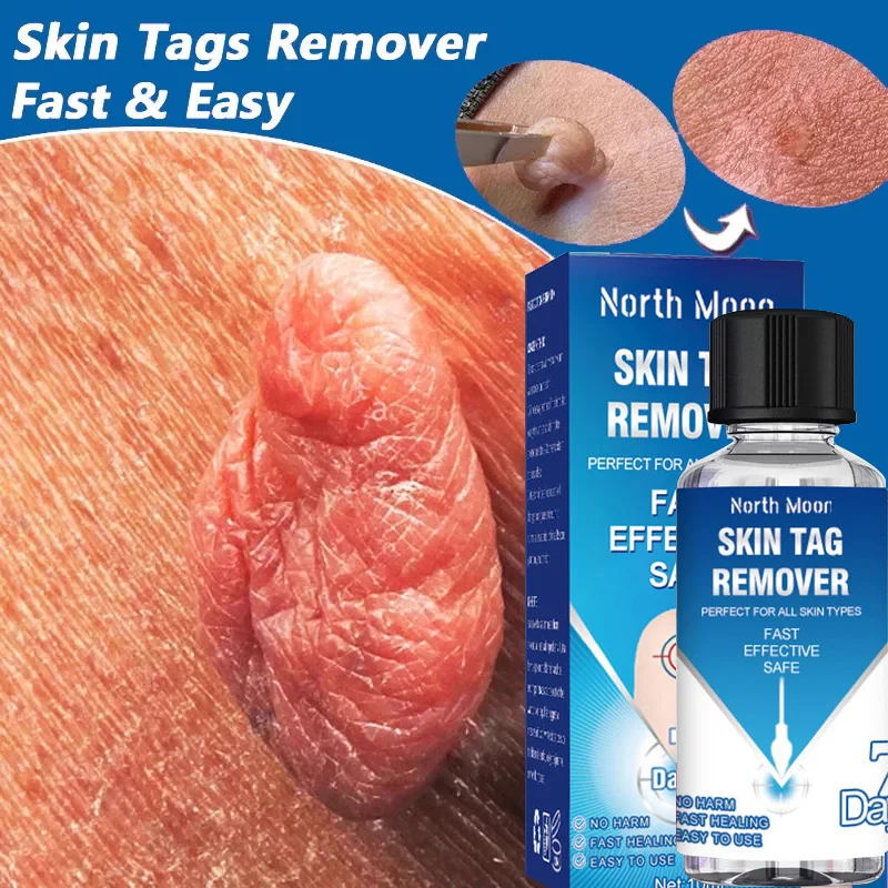 

Warts Remover Serum Skin Tags Treatment Foot Corn Body Dark Spot Mole Face Flat Wart Removal Cream Essential Oil