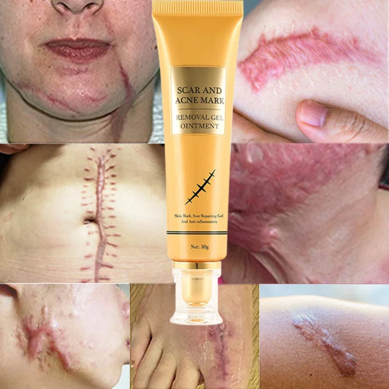 

Acne Pimples Stretch Marks Scar Removal, Scar Removal Cream For Old Scars On Face And Legs,Body Scar Removal Cream