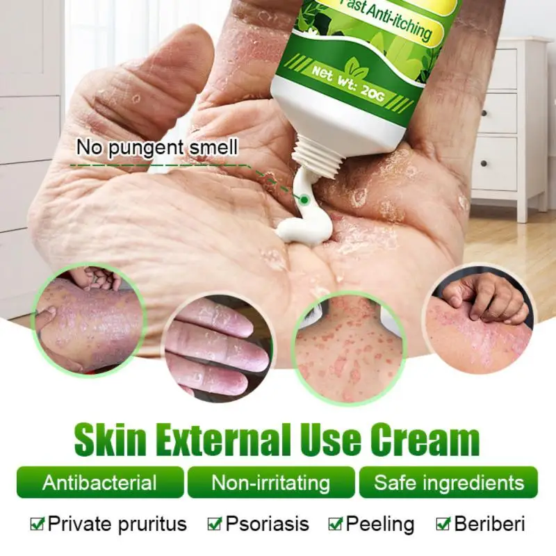 

20g Psoriasis Cream Eczema Ointment Scalp Psoriasis Hand Tinea Foot Odor Tinea Versicolor Inhibit Fungus Anti-itch Cream