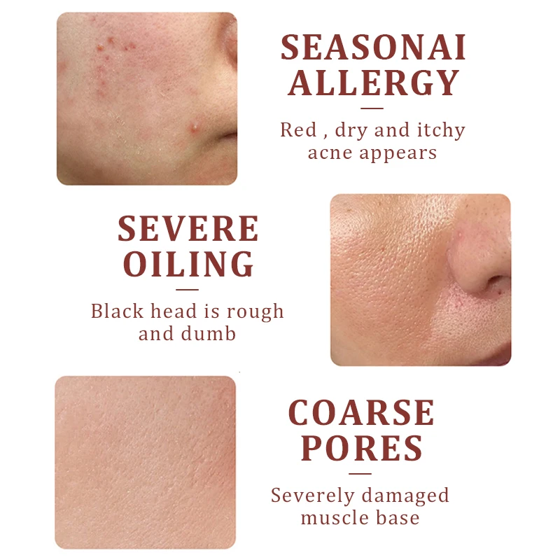 Сыворотка для лица с календулой женщин эссенция содержит салициловую кислоту