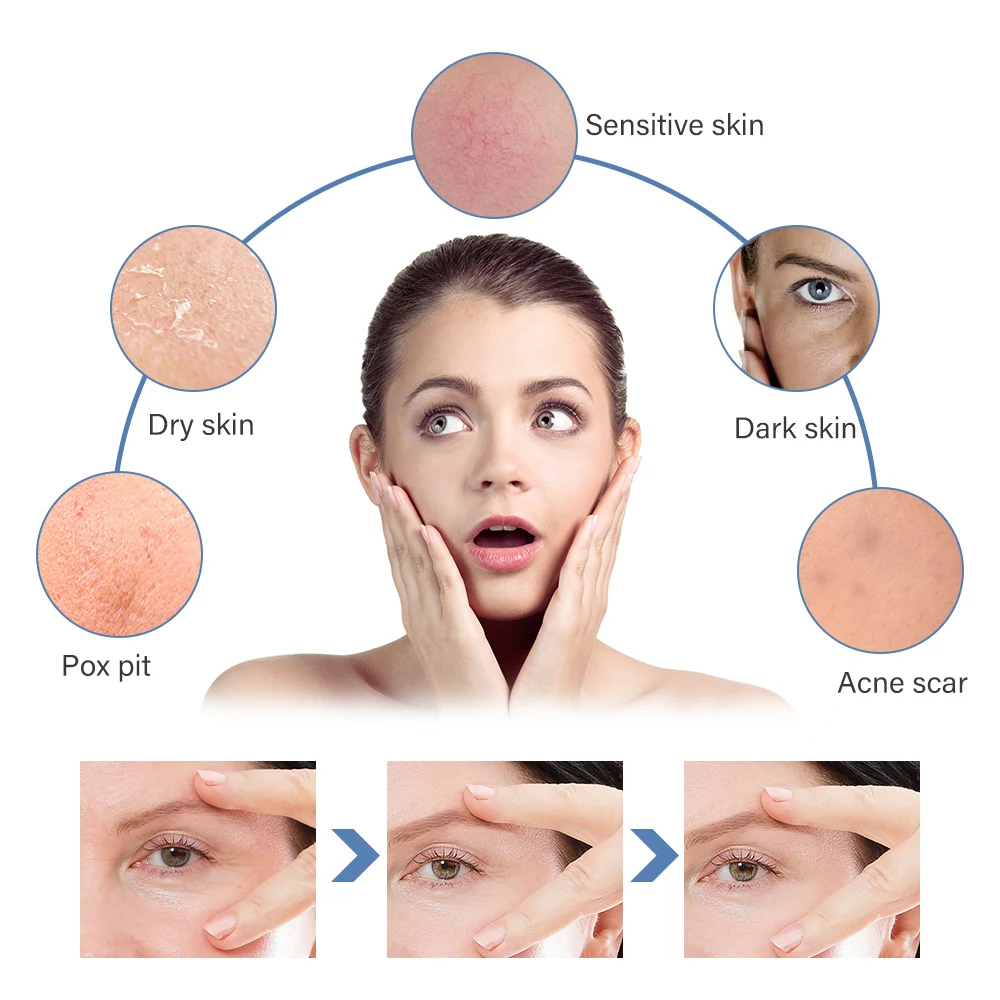 Беспроводной Ultima дермы ручка H3 + профессиональная электрическая микроигла лица