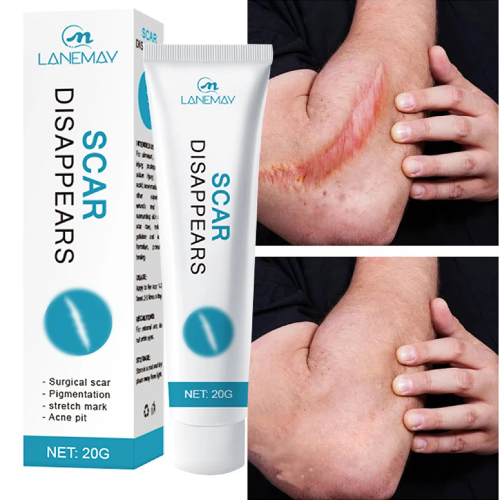 

Scar Removal Cream Acne Scars Surgical Stretch Marks Remove Spots Repair Burn Treatment Smoothing Moisturizer Skin Care Products