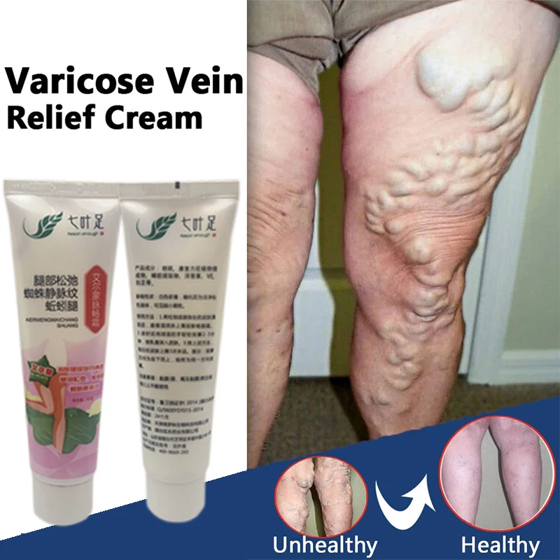 

3pcs 20g Natural Varicose Veins Ointment Leg Vasculitis Analgesics Cream Spider Shape Vein Phlebitis Relief Pain Care Dressing