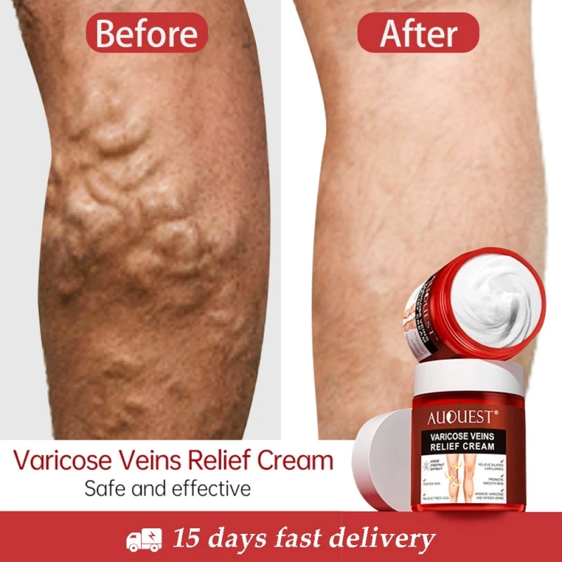 

Effective Varicose Veins Relief Cream Soothing Vasculitis Phlebitis Spider Pain Treatment Herbal Medical Ointment Body Skin Care