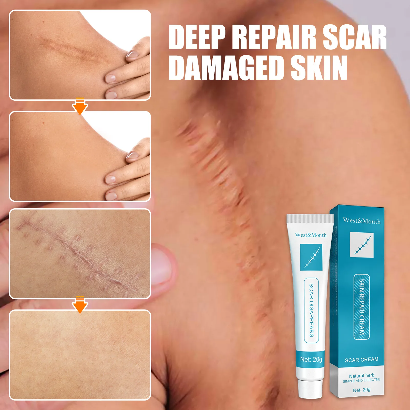 Scar Repair Cream Fade Hyperplasia Pregnancy Operation Burn Scar Skin Repair Scar Cream Body Care Scar Repair C Section Scar