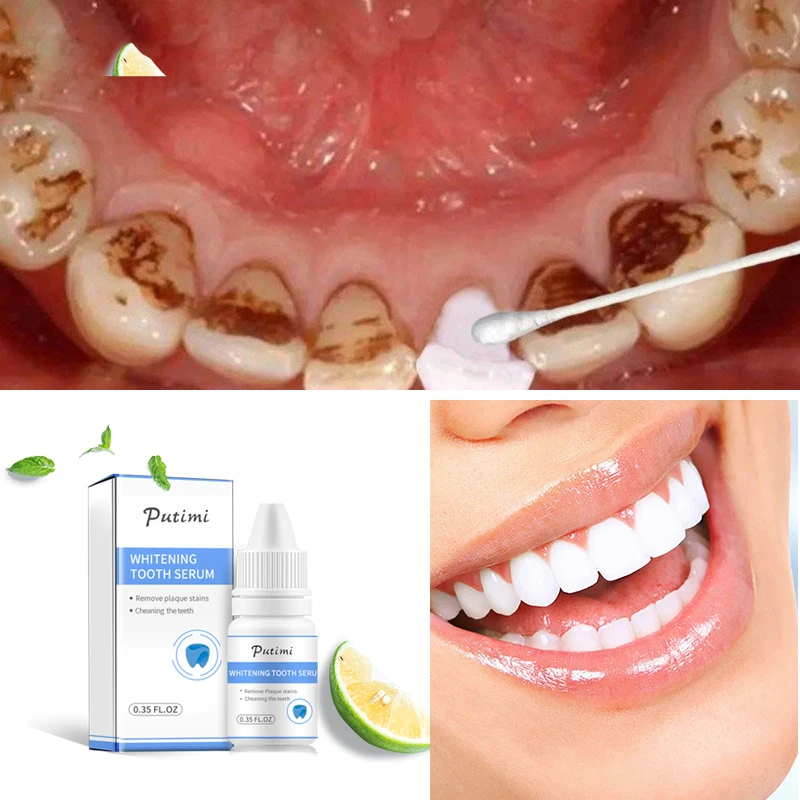 

Эссенция для отбеливания зубов PUTIMI, гигиена полости рта, чистящая сыворотка, порошок для удаления зубного налета, инструмент для отбеливани...