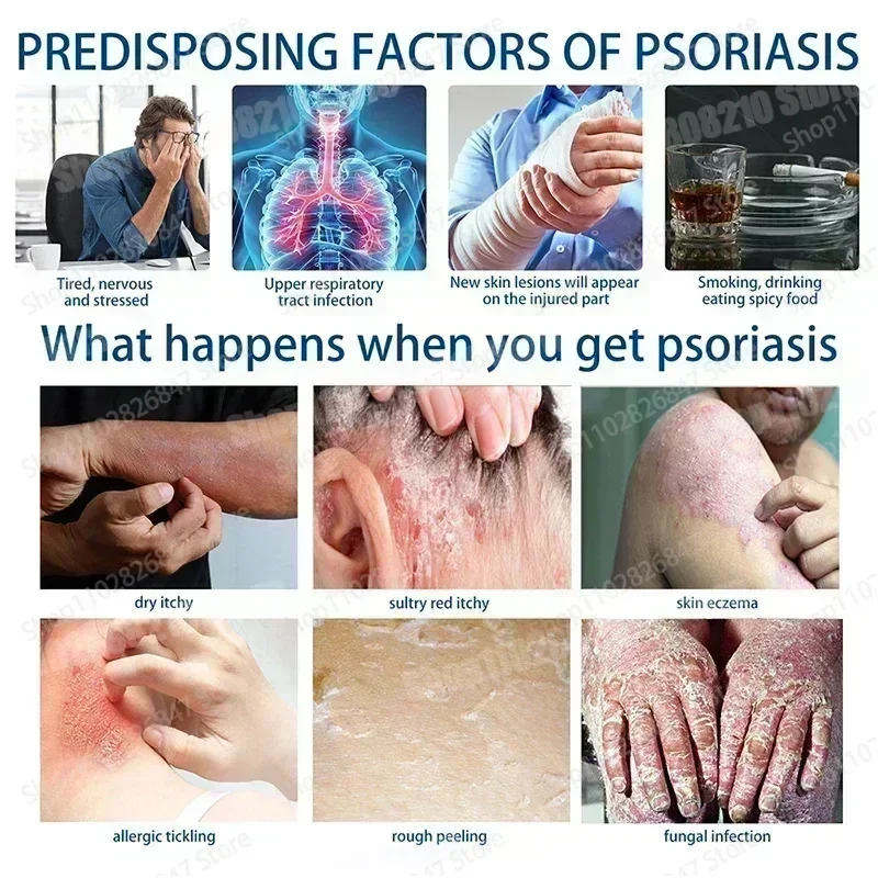 Мазь от псориаза идеально подходящая для проблем на коже крем противозудный