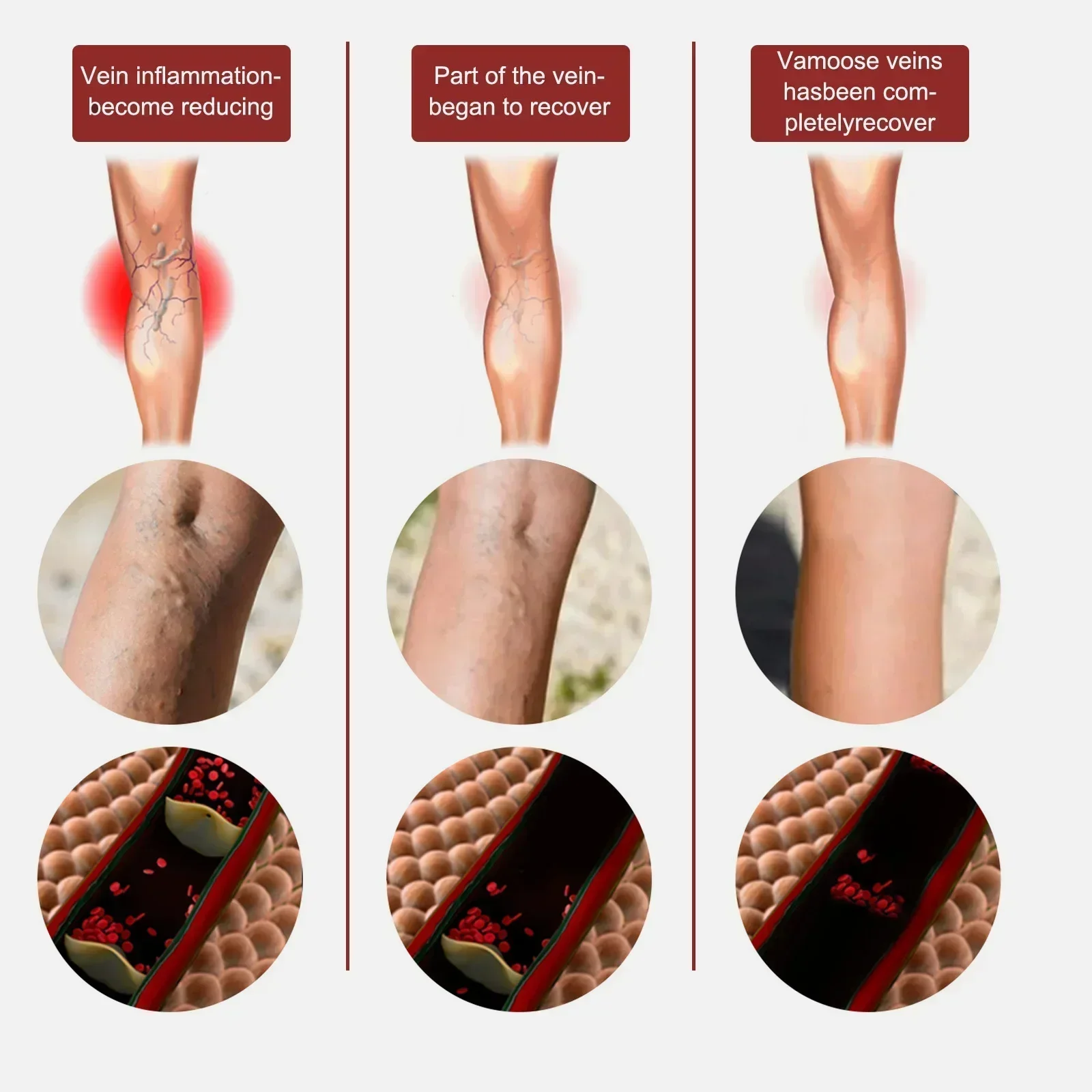 Varicose Vein Treatment Leg Health Ointment Effectively Removing Spider Veins2210
