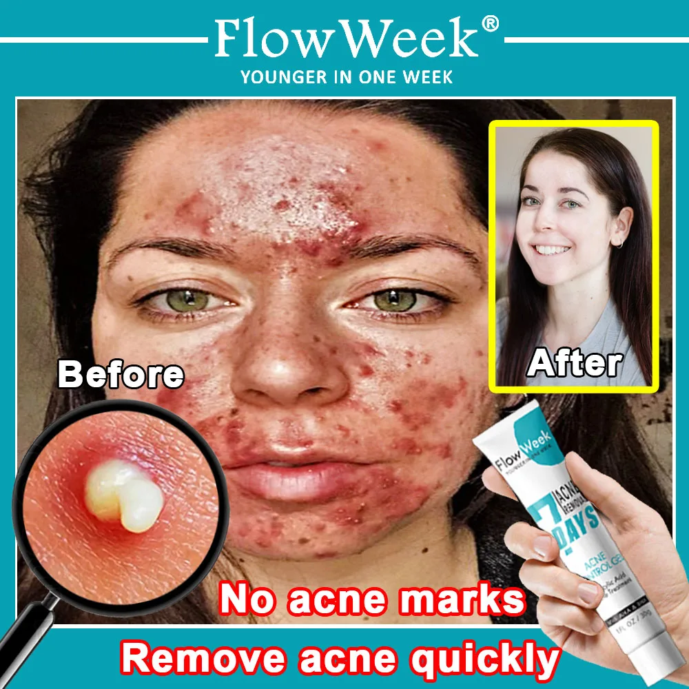 

FlowWeek Salicylic Acid Anti-Acne Gel Acne Removal Cream Remove Pimple Blackhead Treatment Shrink Pore Oily Control Skin Care