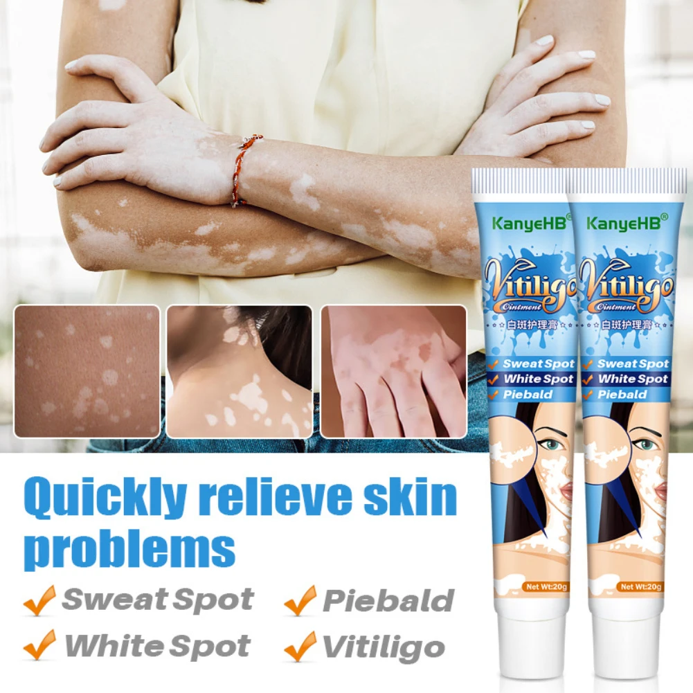 

White Tag Cream Treatments Gently Repair Moisturizing Cream Reduces White Spots Fades Skin Marks Skin Vitiligo Care For Adults