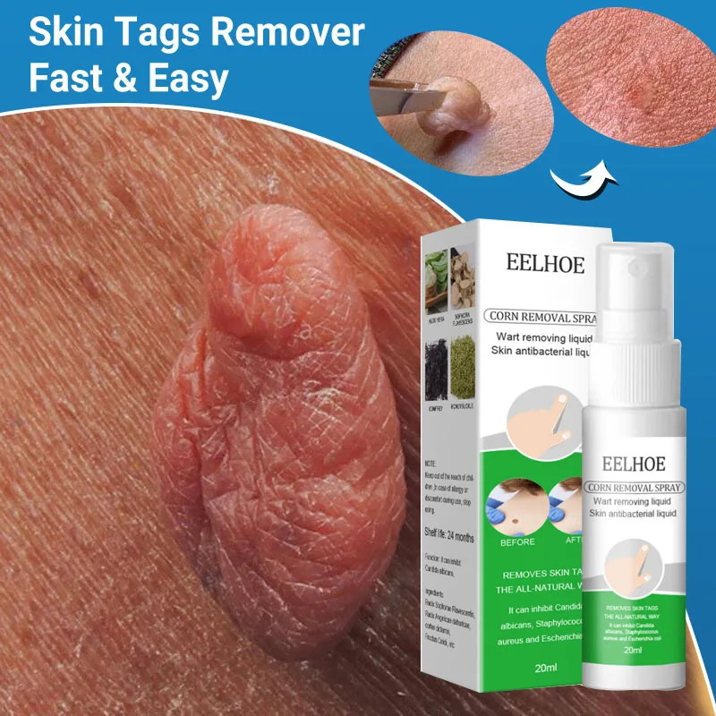 

Herbal Warts Remover Spray Painless Mole Skin Tags Dark Spots Removal Serum Treatment Papillomas Genital Flat Wart Care