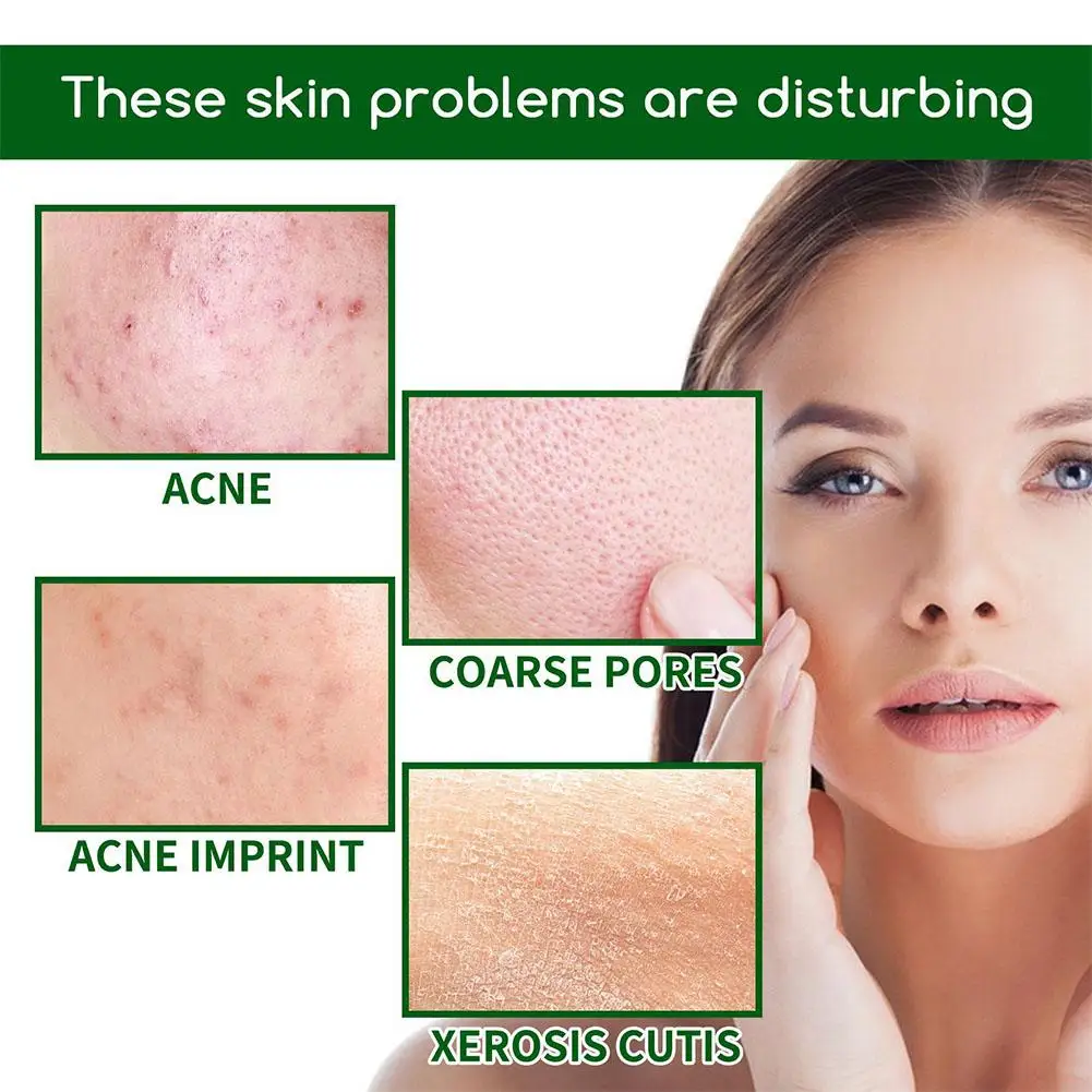 Салициловая кислота от пр. Eunyul lab acne solution calamine bubble foam. Акне салициловый. Мази и крема от прыщей. Салициловая кислота от прыщей.