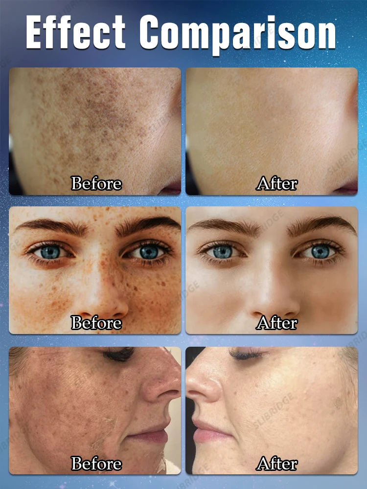 Fre-ckles Mela-sma Removal Da-rk Sp-ots Средство для удаления лица