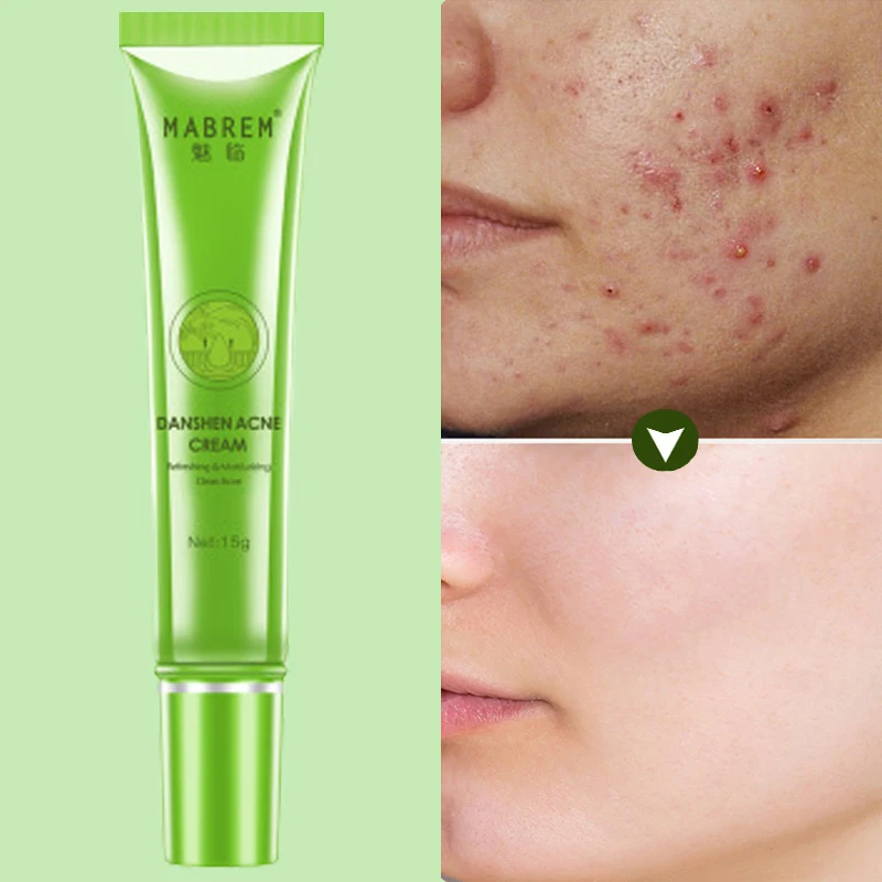 

Effective Acne Removal Cream Acne Treatment Repair Fade Pimple Spots Oil Control Shrink Pores Whitening Moisturizing Skin Care
