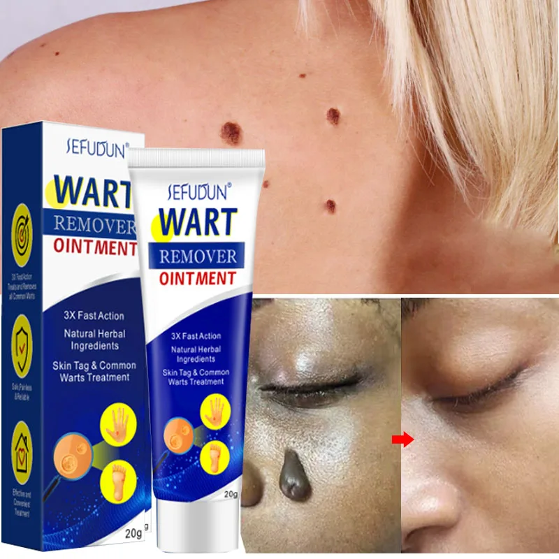 

Wart Removal Ointment Antibacterial Cream Papillomas Mole Remedy Skin Tags Flat Genital Foot Corn Treatment Medical Plaster 20g