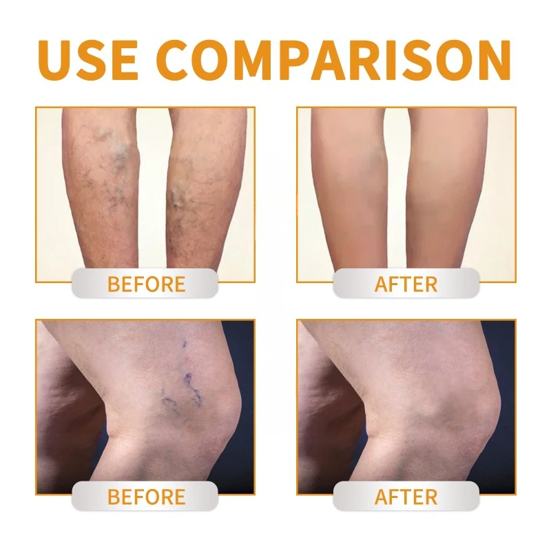 Крем с витамином K для лечения варикозного расширения вен флебит варикозное