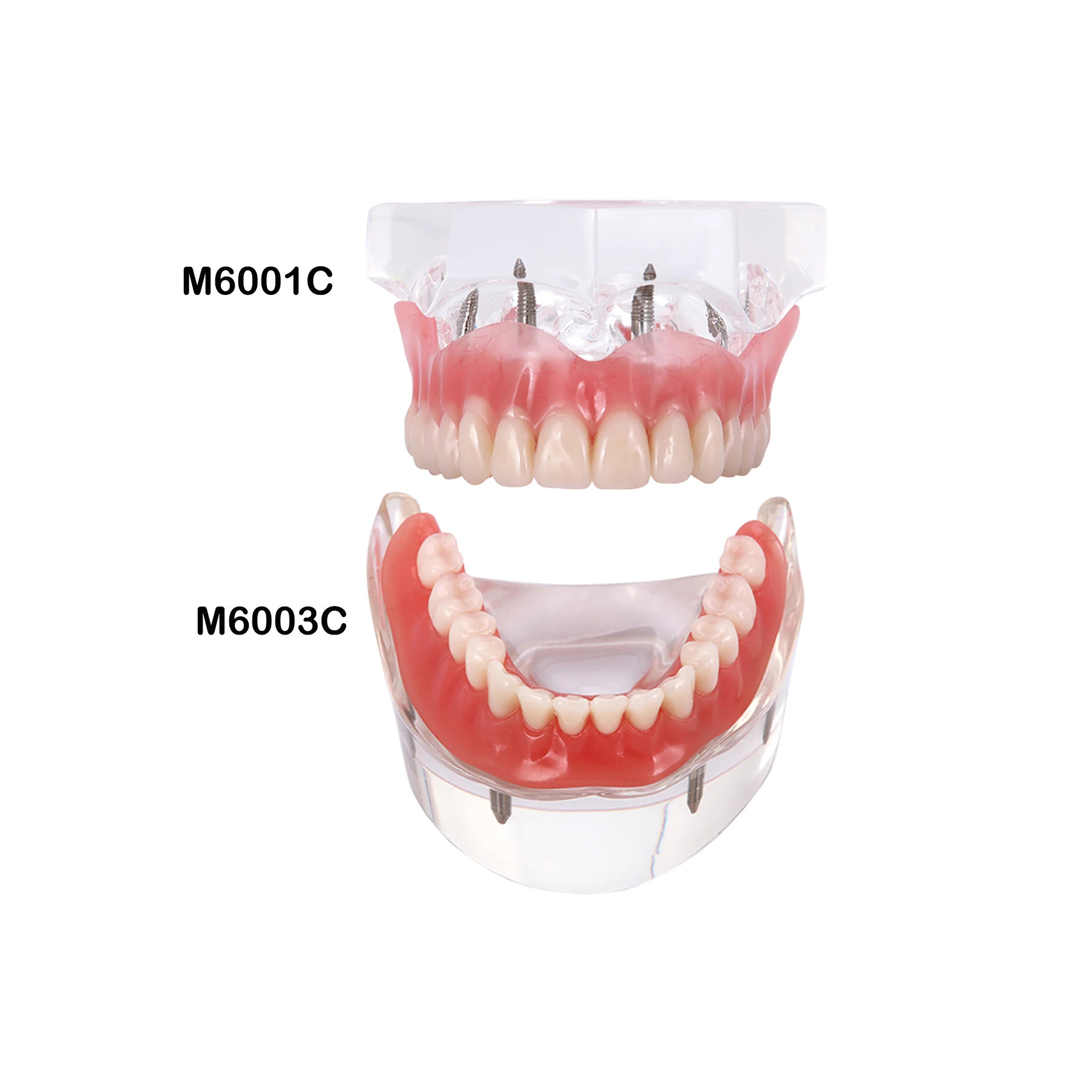 

Dental Teeth Model With 4 Implants Overdenture Restoration Model For Dentist Patient Communication Demo